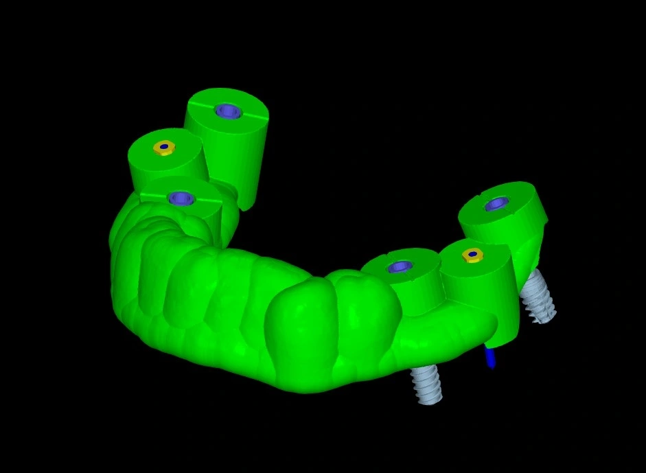 implantología digital 